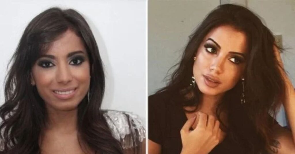 Anitta before surgery